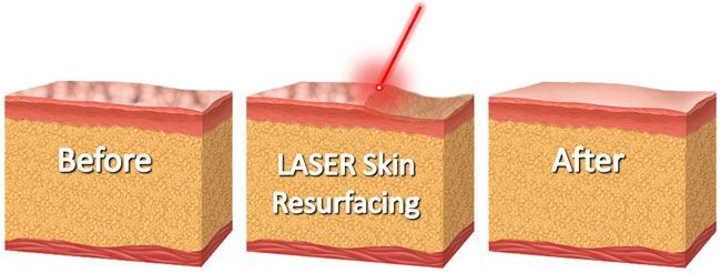 Read more about the article Laser dermabrasion treatment at Dischem Salon