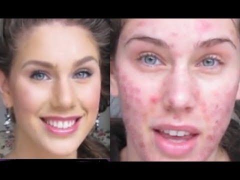 Read more about the article Foundation Routine Flawless Skin (Full Coverage, Fingertips) Acne Scaring