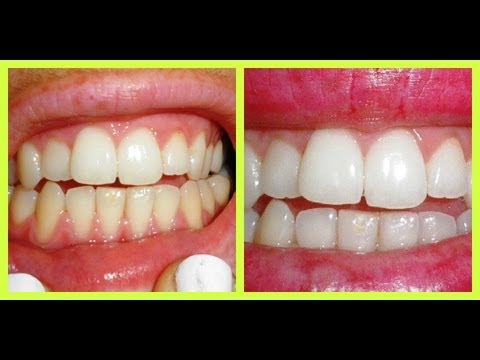 Read more about the article DIY teeth whitener