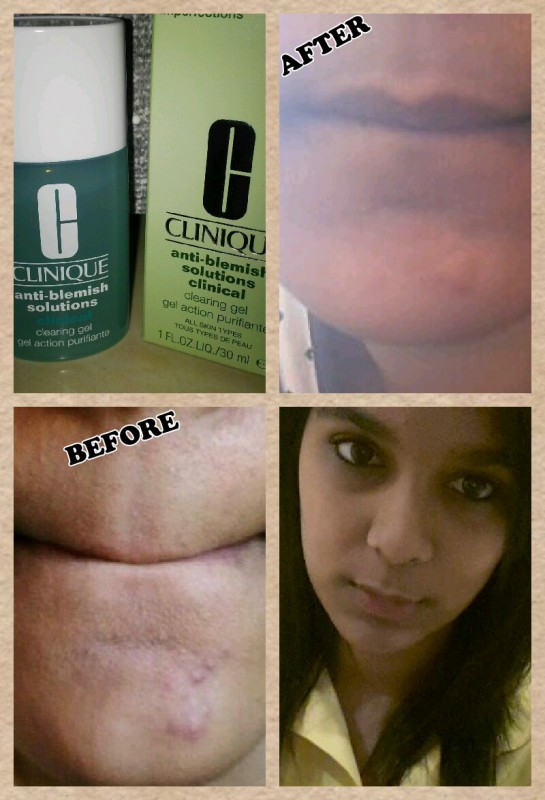 Read more about the article Clinique Anti Blemish Solutions