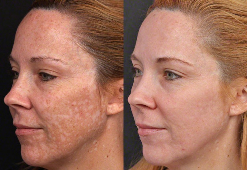 Read more about the article Depigmentation Treatment