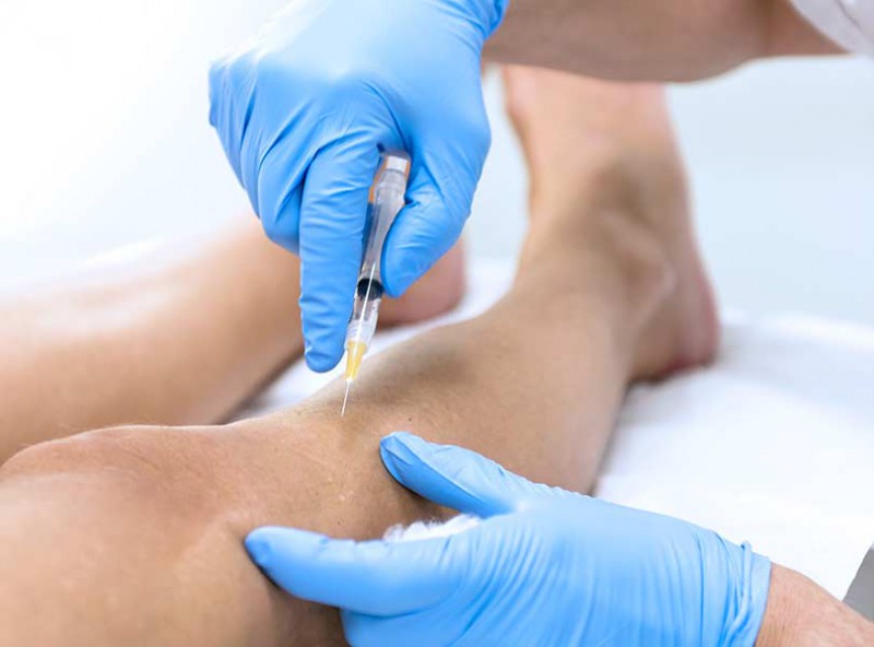 Read more about the article Sclerotherapy