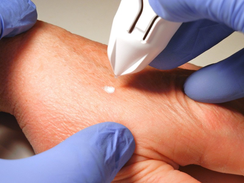 Read more about the article Hand Rejuvination: Laser Skin Resurfacing