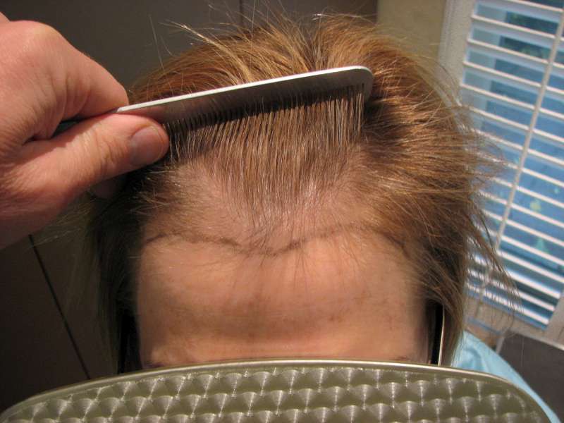 Read more about the article Hair Restoration