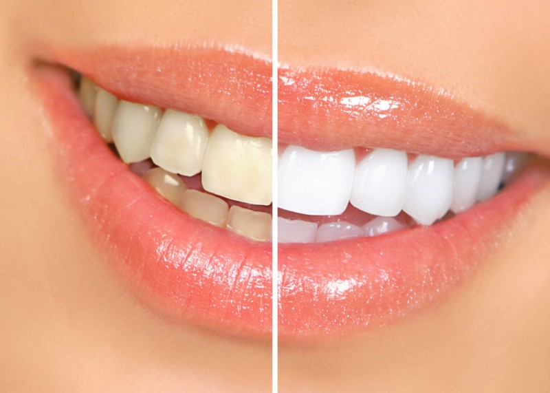 Read more about the article 1 Hour express teeth whitening