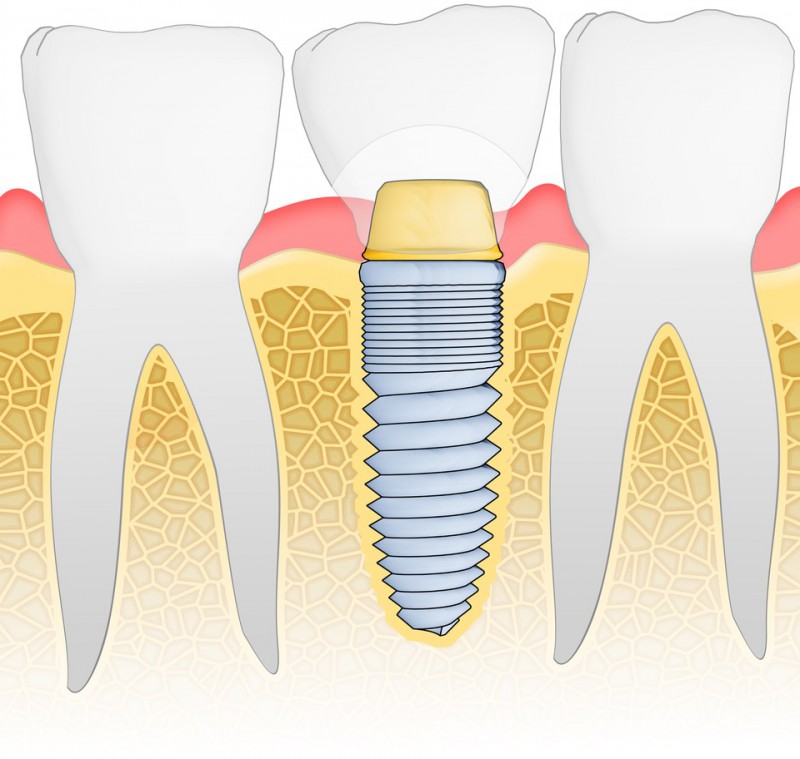 Read more about the article Dental implants